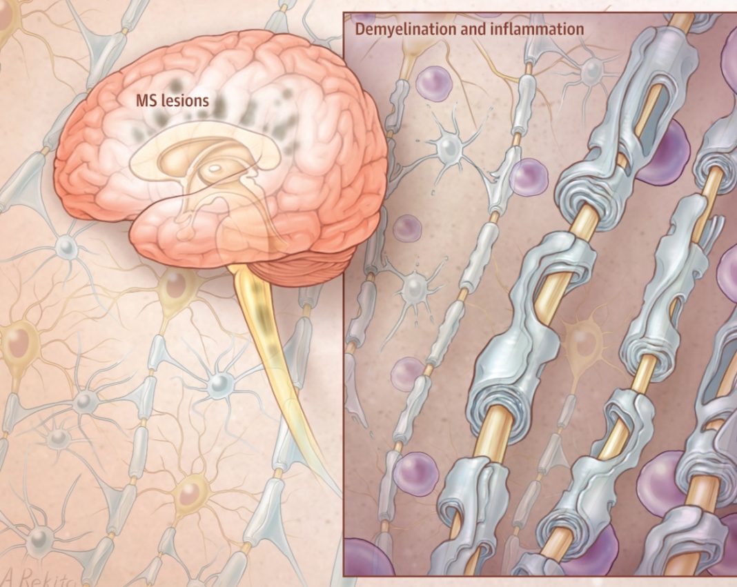 Склероз и диета быстро Склероз и диета быстро